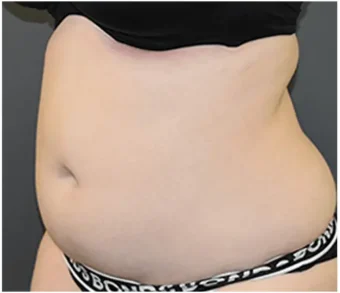 pic-432x501-result-1-before