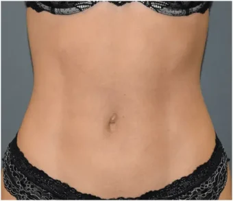 pic-432x501-result-3-after