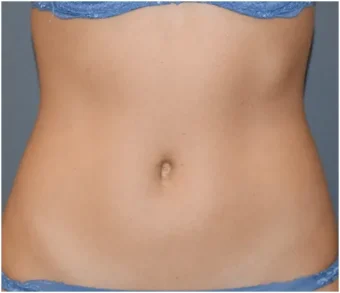 pic-432x501-result-3-before